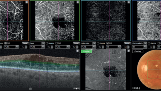 The Ophtalmologist - Cas cliniques en OCT-A